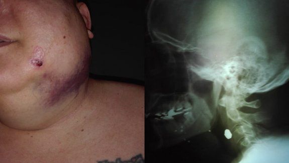 El médico trabajaba en el hospital de Campo Grande y sufrió tres tiros, uno en la cara, otro en el cuello y el tercero en un brazo. El atacante fue condenado tanto penal como civilmente.&nbsp;
