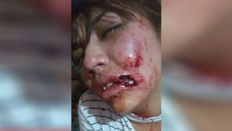 Brutal: atacó a mordidas a su novia y le arrancó parte del labio