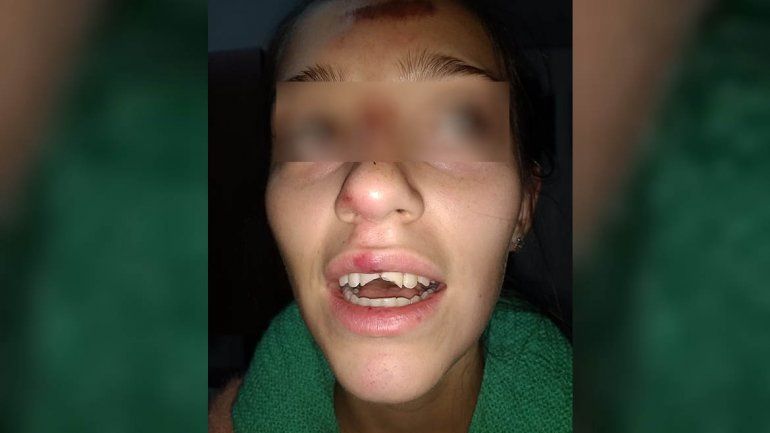 Brutal ataque de perros a una joven estudiante en el barrio Pichi Nahuel