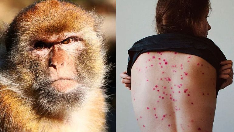 Alerta mundial: la viruela del mono se expande en varios países