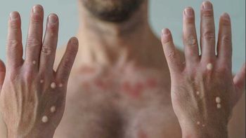 El caso de esta variante de viruela se informó en el Boletín Epidemiológico. | LMCipolletti.com El caso de esta variante de viruela se informó en el Boletín Epidemiológico.