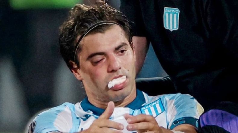 Cómo le quedó el rostro a Santiago Sosa luego de la operación por la fractura que le hizo Marcos Rojo | LMCipolletti.com Cómo le quedó el rostro a Santiago Sosa luego de la operación por la fractura que le hizo Marcos Rojo