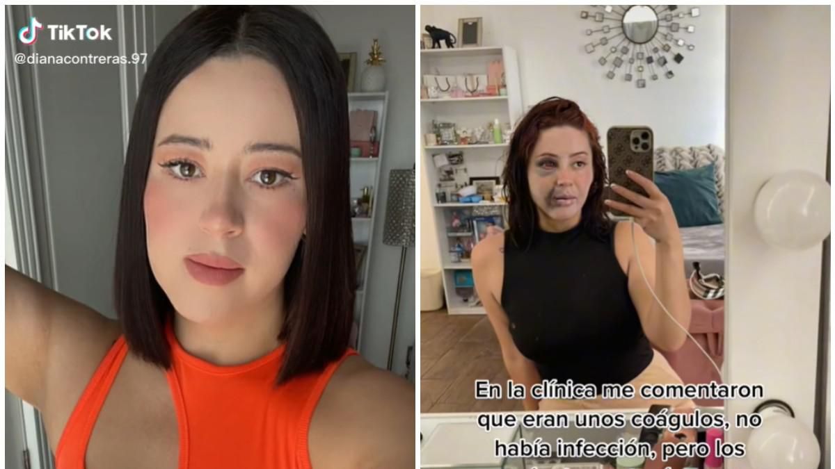 Tiktoker se hizo una bichectomía y quedó desfigurada