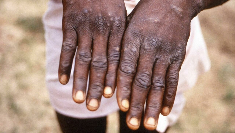 Viruela del mono: detectan el primer caso sospechoso en Argentina