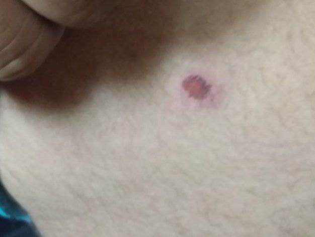 Denuncian a policías por perseguir y dispararle a un joven. Una de las presuntas heridas.&nbsp;