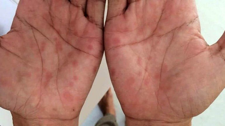 Alerta por el incremento de casos de sífilis en Río Negro