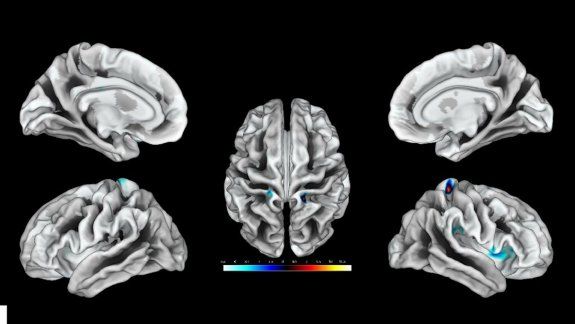 Confirmado: el cerebro humano es cada vez más grande