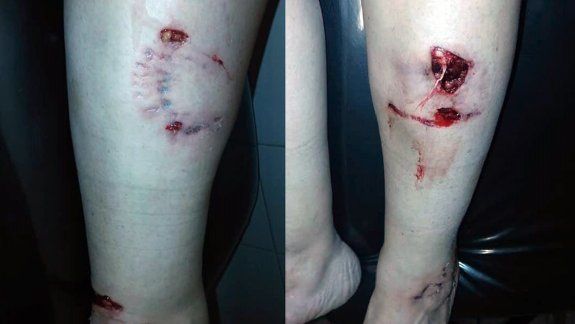 Una cipoleña fue brutalmente atacada por un pitbull