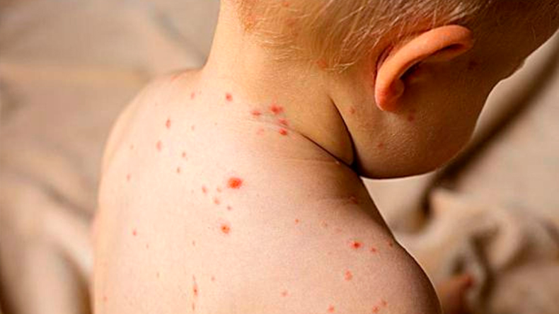 Argentina confirma casos de sarampión y Chile lanza una alerta epidemiológica. | LMCipolletti.com Argentina confirma casos de sarampión y Chile lanza una alerta epidemiológica.