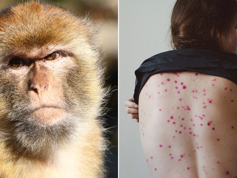 Confirman el séptimo caso de viruela del mono en Argentina