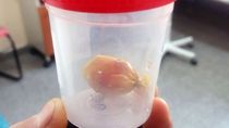 El envoltorio que había tragado el preso de Viedma, y que luego expulsó junto con material fecal. Las pericias posteriores revelaron que era cocaína. El envoltorio que había tragado el preso de Viedma, y que luego expulsó junto con material fecal. Las pericias posteriores revelaron que era cocaína.